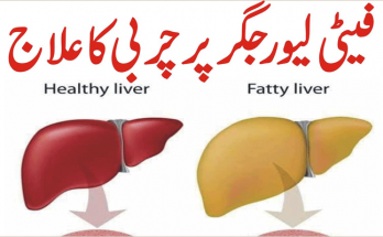 Fatty Liver