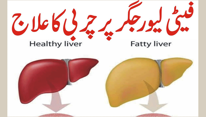 Fatty Liver