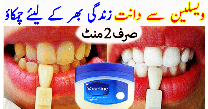 Teeth Whitening Treatment