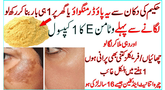 Get Rid Of Discoloration And Freckles