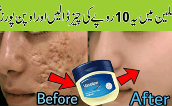 Get-Rid-of-Large-Pores-Naturally