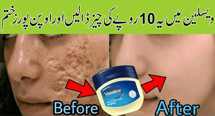 Get-Rid-of-Large-Pores-Naturally