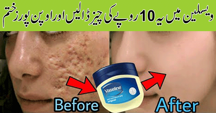 Get Rid of Large Pores Naturally