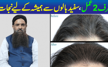 Grey Hair Causes and Treatment