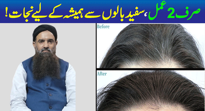 Grey Hair Causes and Treatment