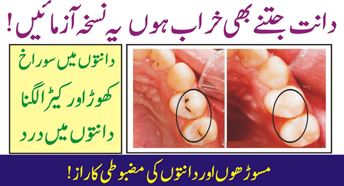 Tooth Cavity Treatment