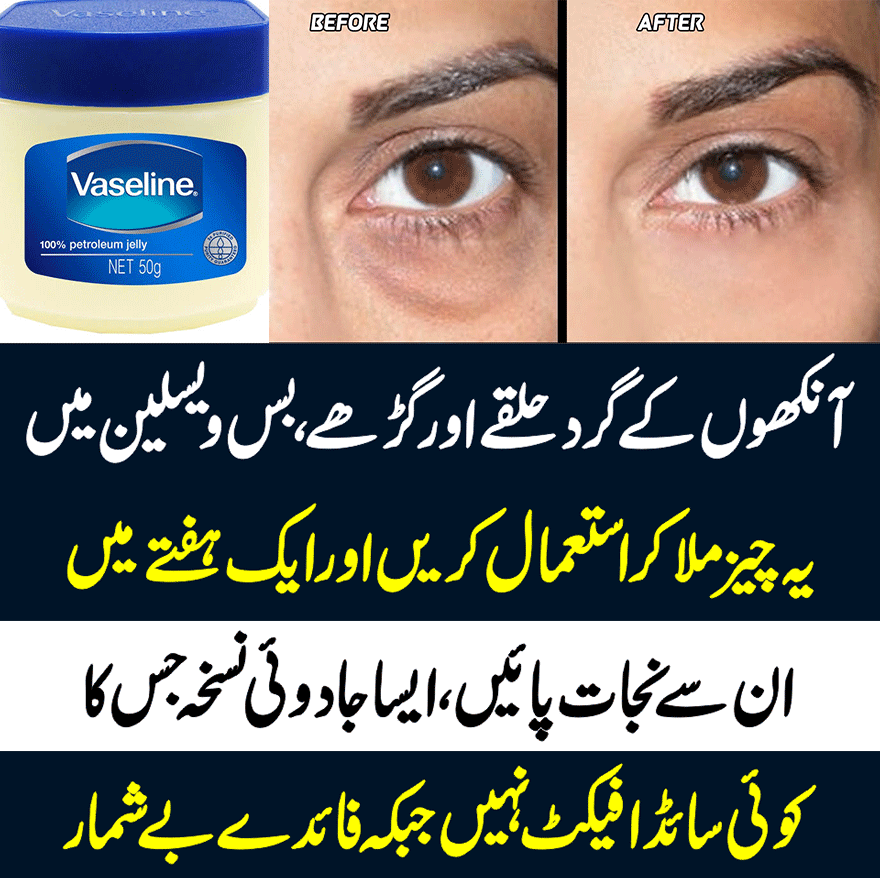 Get Rid of Dark Circles Under Eyes Natural Home Remedies