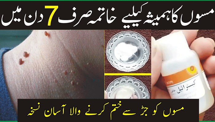 Moles and Common Warts Removal Home Remedies