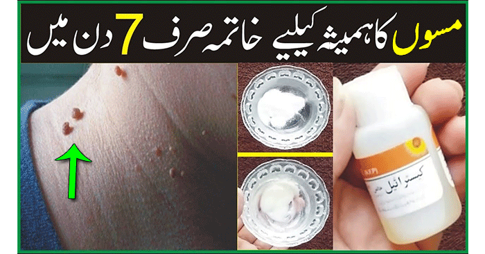Common Warts Removal Home Remedy