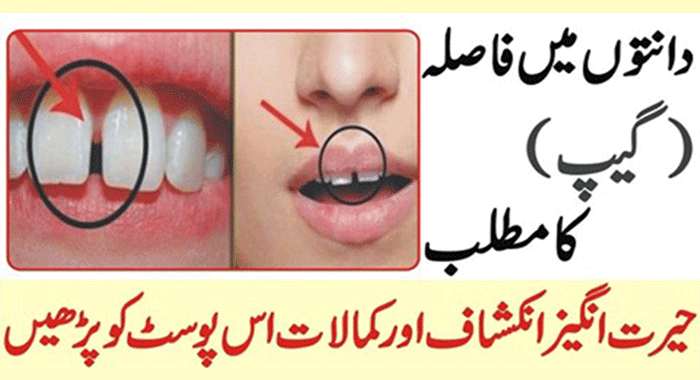 Gap in Teeth Meaning