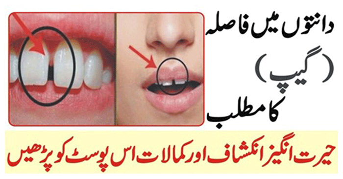 Gap in Teeth Meaning