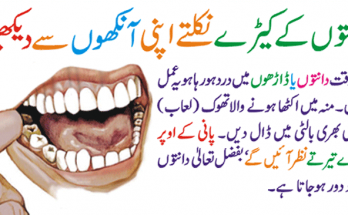 How to Prevent Dental Caries and Treatment