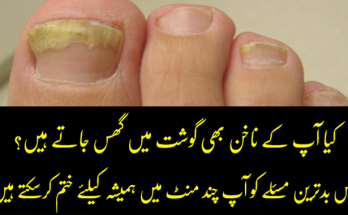 Get-Rid-of-Fungal-Nail-Naturally