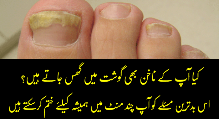 Get-Rid-of-Fungal-Nail-Naturally