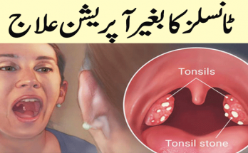 Get Rid of Tonsils by Natural Home Remedies