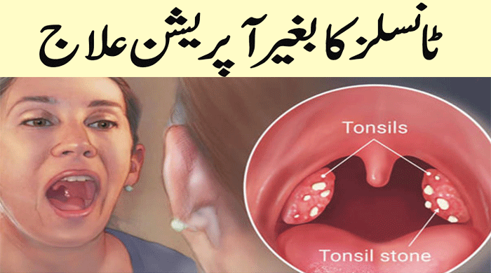 Get Rid of Tonsils by Natural Home Remedies